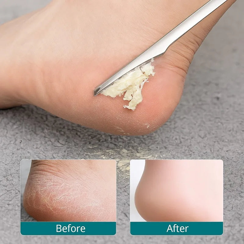 2pcs Double-Sided Foot Callus File & Dead Skin Scraper Set